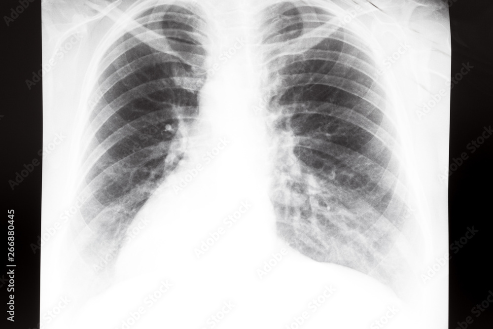 human thorax with lungs on X-ray image human thorax with lungs on X-ray image