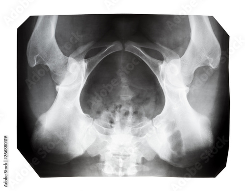 film with X-ray image of human female pelvis photo