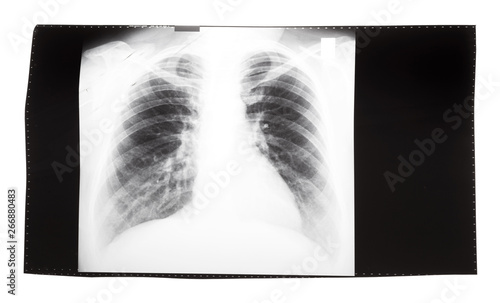 film with X-ray image of human thorax photo