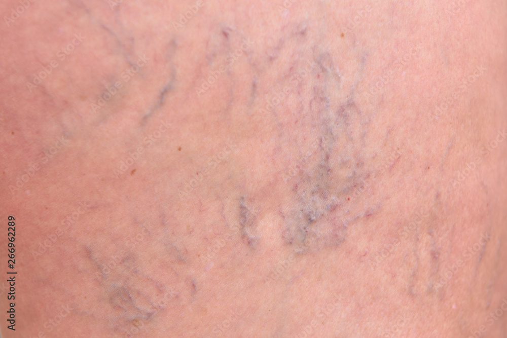 Varicose veins on female legs in the hips. Sipder veins thigh, close-up