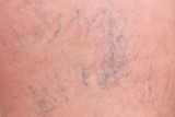 Varicose veins on female legs in the hips. Sipder veins thigh, close-up