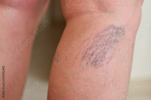 Varicose veins on female legs in the area of the knee and calves. Sipder veins thigh  close-up