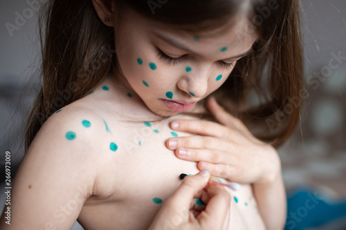Fotografie portrait of a girl suffering from chickenpox