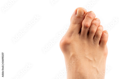 Photos woman food with hallux valgus