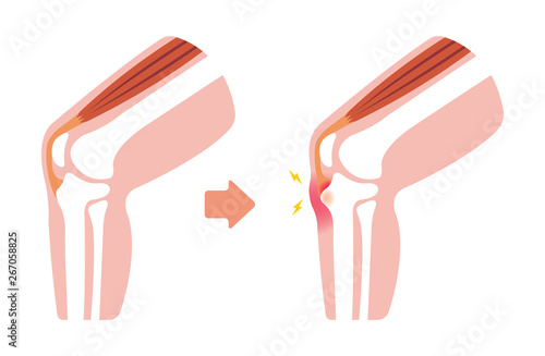 Osgood-schlatter disease (knee joint disease) illustration (no text) photo