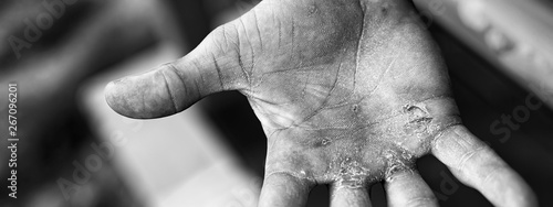 Palm with Calluses. Hard Work Concept. Blisters on the Injured Hand From Manual Work.