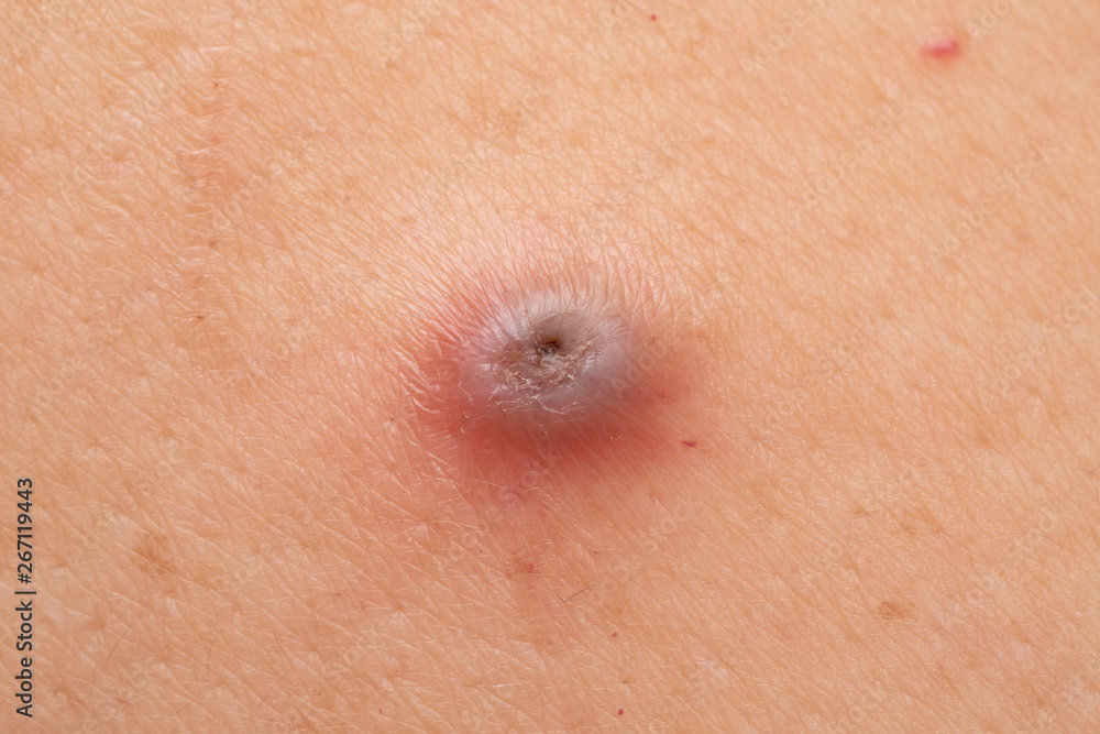 Folliculitis with Skin Inflammation which can be a skin cancer  in the future