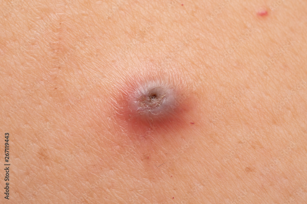 Fototapeta premium Folliculitis with Skin Inflammation which can be a skin cancer in the future
