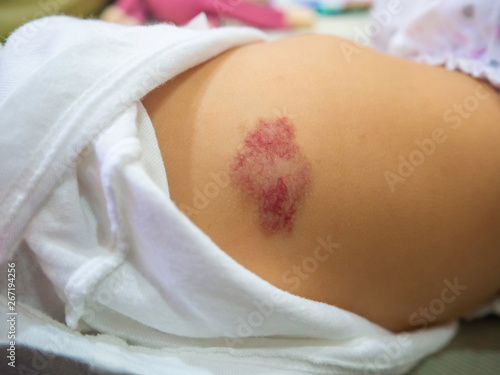 Capillary hemangioma red birthmark on the baby's body.