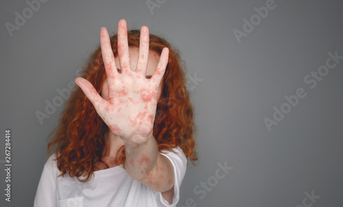 Stop Measles. Woman With Red Spots Over Grey Background photo