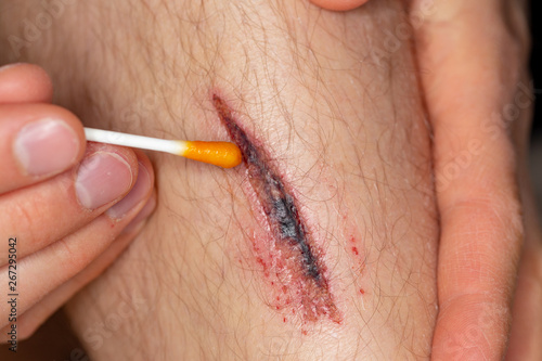 Deep gash on the leg of a young male person is getting disinfected with iodine
