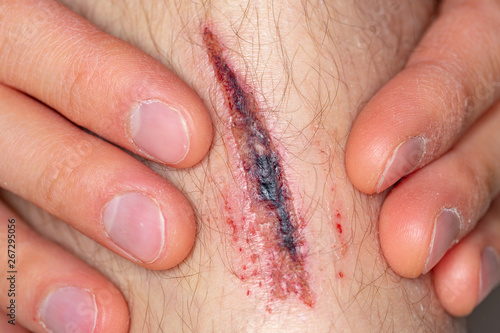 Fotografia Deep gash on the leg of a young male person