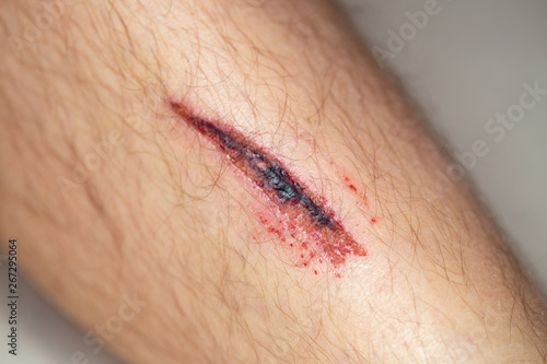 Deep gash on the leg of a young male person