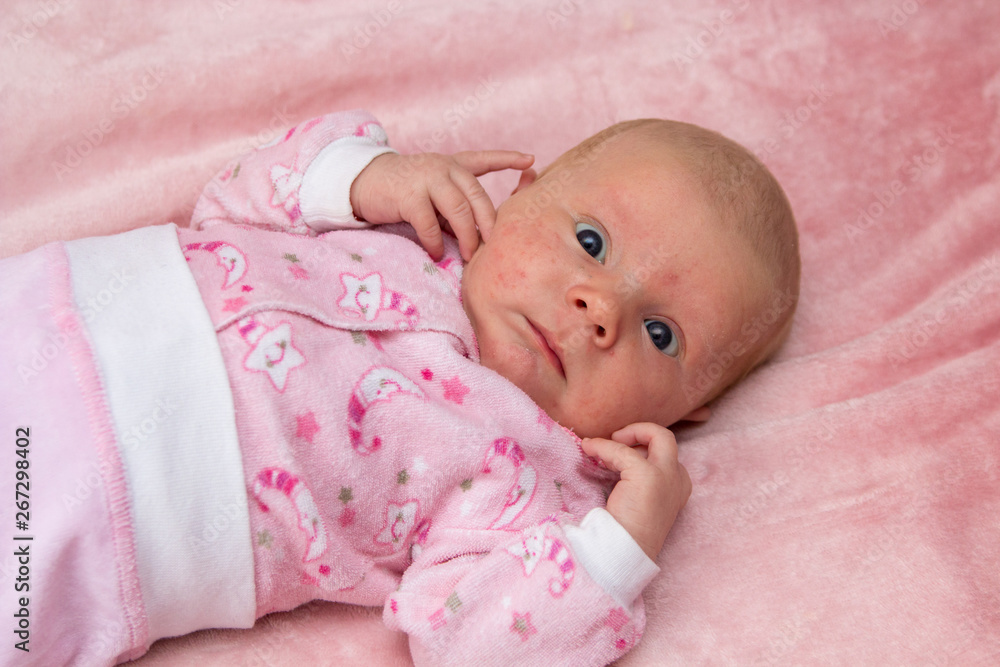 newborn girl with pimples,The baby lies on the bed and has allergies, rashes on the face of the newborn newborn girl with pimples,The baby lies on the bed and has allergies, rashes on the face of the newborn