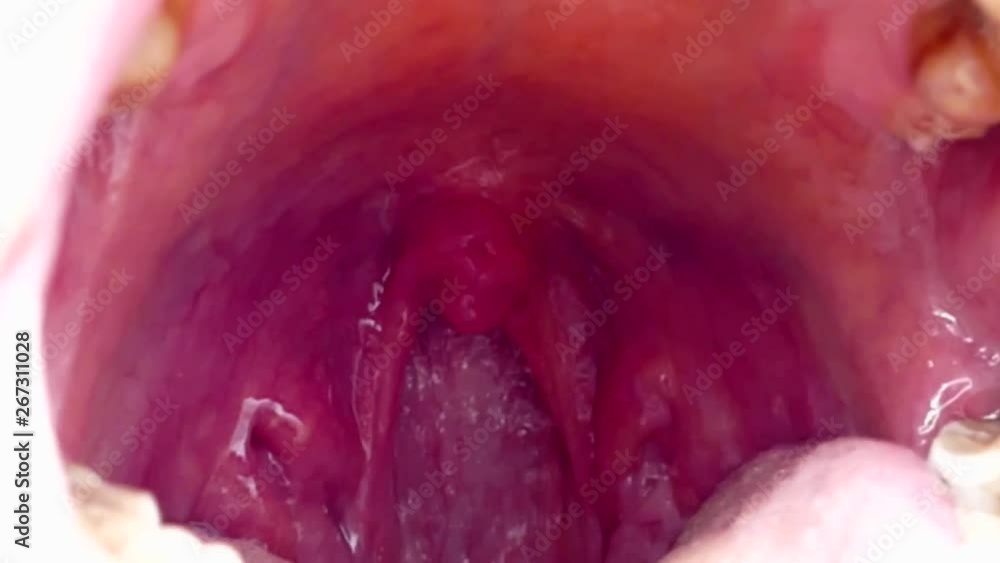 tonsils deformed, tonsillitis, neglected poor human mouth interior