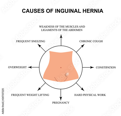 Causes of inguinal hernia. Infographics. Vector illustration on isolated background.