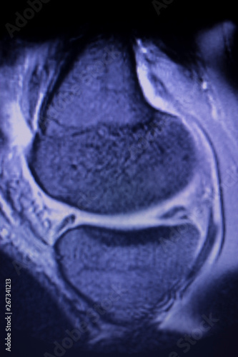 MRI knee meniscus tear scan photo