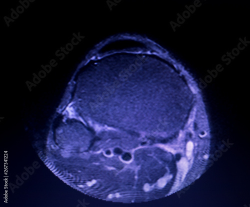 MRI knee meniscus tear scan photo