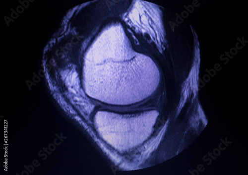 Photography MRI knee meniscus tear scan
