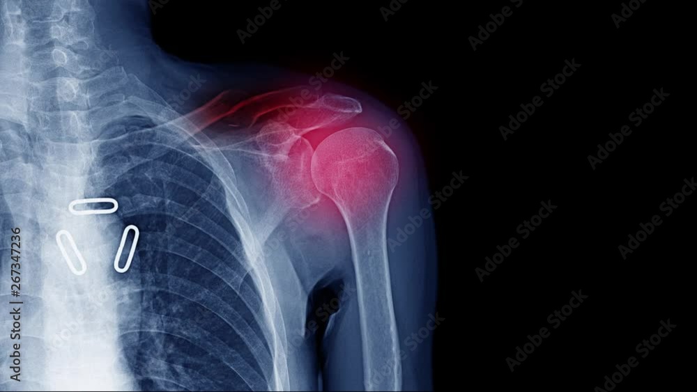 footage of xray shoulder pain or frozen shoulder Stock ビデオ Adobe Stock