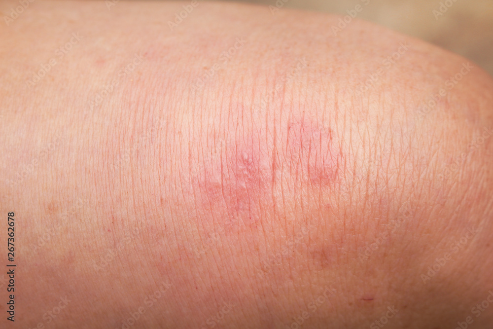 Woman have red rash allergy on knee leg top view background Woman have red rash allergy on knee leg top view background