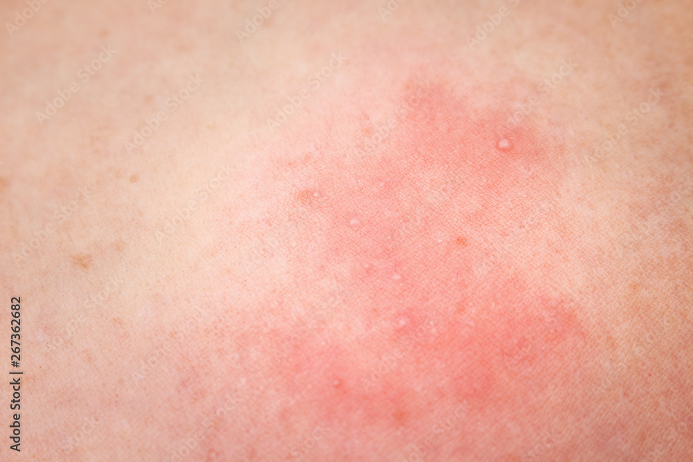 Woman have red rash allergy on her leg closeup skin background
