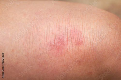 Woman have red rash allergy on knee leg top view background