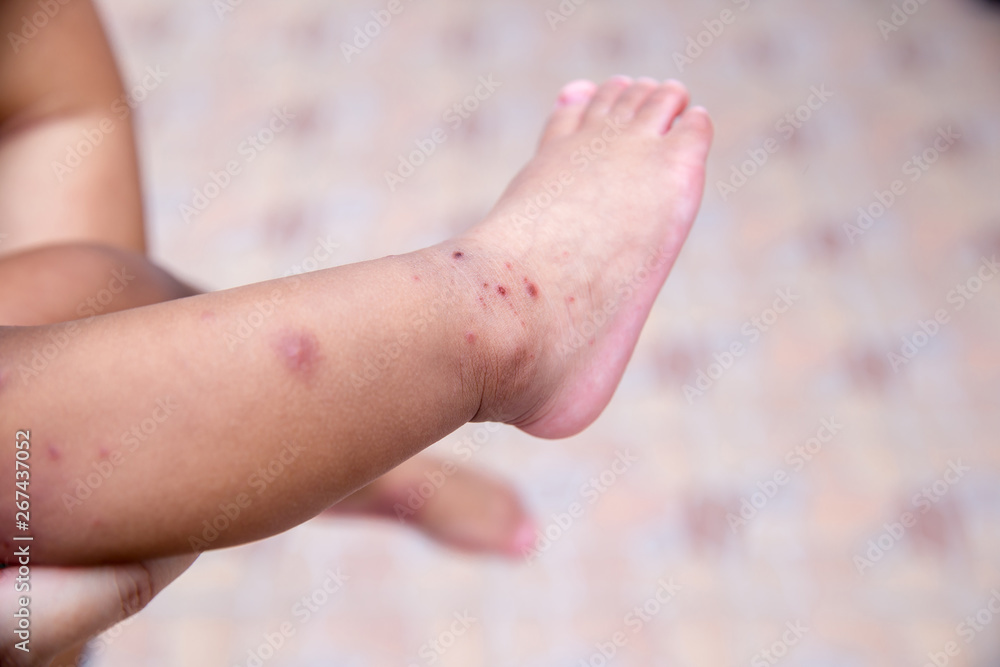 Boy with symptoms hand, foot and mouth disease . children " HFMD " with