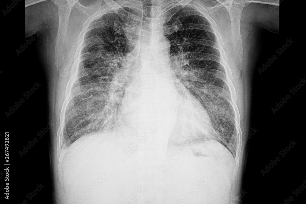 chest xray film of a patient with cardiomegaly Stock Photo | Adobe Stock