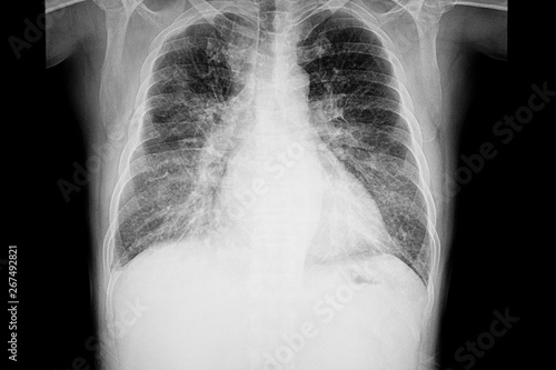 chest xray film of a patient with cardiomegaly
