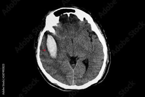 CT scan of a large intracerebral hemorrhge of the brain photo