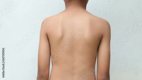 Asian kid with scoliosis photo