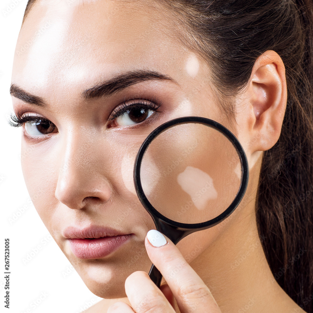 Beautiful woman with vitiligo holds magnifying glass. Beautiful woman with vitiligo holds magnifying glass.