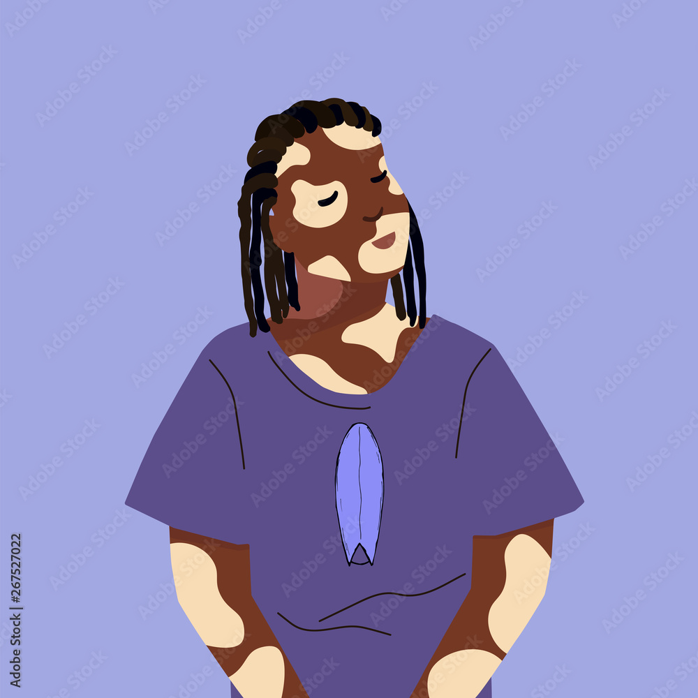 Dark skinned girl with vitiligo and deep brown dreadlocks. Vector illustration of an african american women with closed eyes and oversize t-shirt with surfboard print. Flat style. Dark skinned girl with vitiligo and deep brown dreadlocks. Vector illustration of an african american women with closed eyes and oversize t-shirt with surfboard print. Flat style.