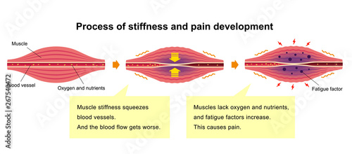 Cause of muscle's stiffness and pain illustration (with explanation texts)