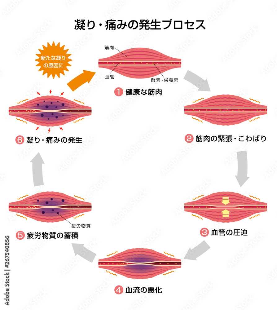 肩こり 凝り 痛みの発生プロセス 6ステップ サークル イラスト Stock ベクター Adobe Stock 肩こり 凝り 痛みの発生プロセス 6ステップ サークル イラスト Stock ベクター Adobe Stock