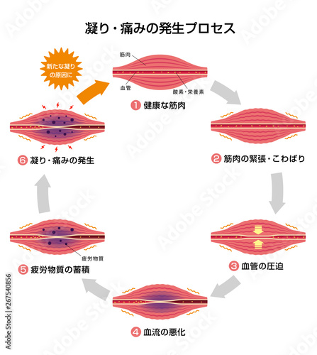 肩こり（凝り）・痛みの発生プロセス (6ステップ/サークル) イラスト
