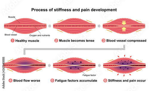 Process of muscle's stiffness and pain  illustration ( 6 steps )
