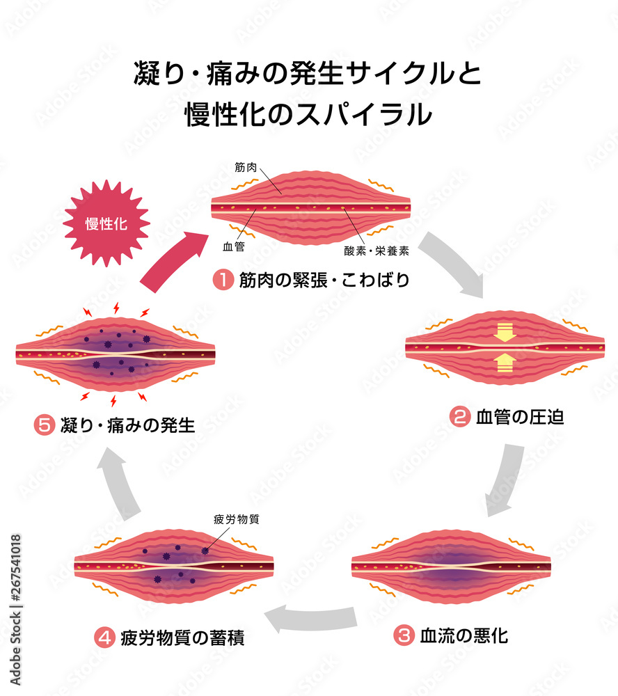 肩こり 凝り 痛みの発生サイクルと慢性化プロセス イラスト Stock ベクター Adobe Stock