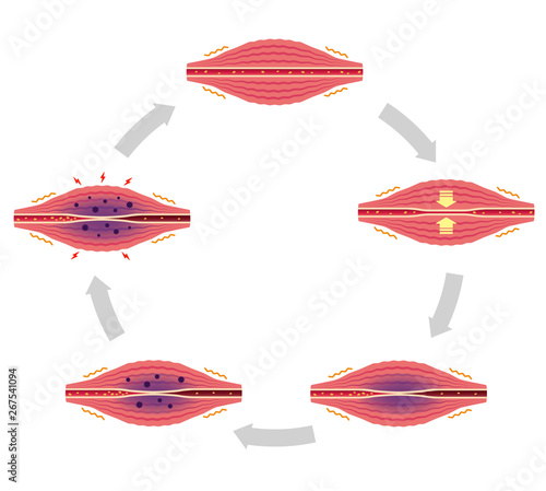 Cycle of stiffness and pain , and spiral of chronicification illustration ( no text)
