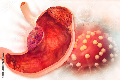 Stomach cancer. Cancer attacking cell. Stomach disease concept