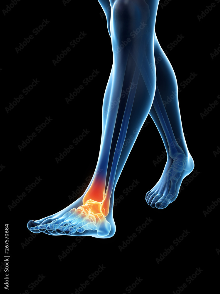 Obraz premium 3d rendered medically accurate illustration of a painful ankle