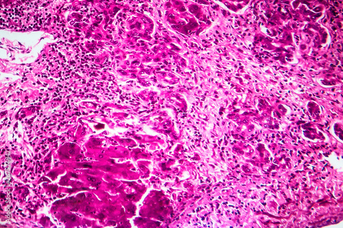 Histopathology of subacute severe hepatitis, light micrograph, photo under microscope