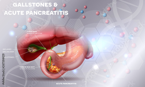 Gallstones and Pancreatitis