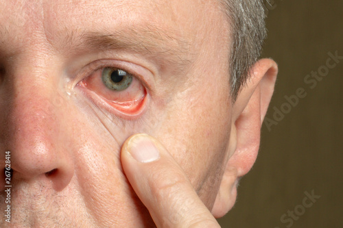Tableau sur toile Close-up male eye with reddened eyelid and cornea, conjunctivitis