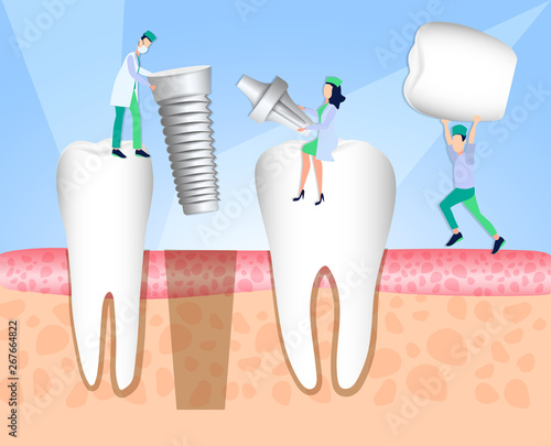 Dentists install a dental implant. Dentistry. Implantation and treatment of human teeth. Vector illustration