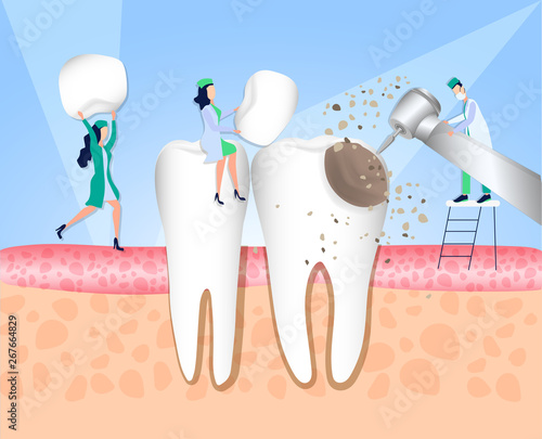 Doctors of the dental clinic carry out treatment of the tooth affected by caries. Violation of enamel, tooth infection, bacteria. Dentistry, treatment of toothache. Vector illustration