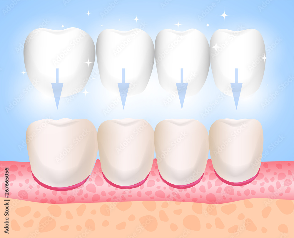 Veneers, Lumineers, onlays, microprosthesis. Installation of veneers. Aesthetic medicine. Direction dentistry orthopedics Veneers, Lumineers, onlays, microprosthesis. Installation of veneers. Aesthetic medicine. Direction dentistry orthopedics
