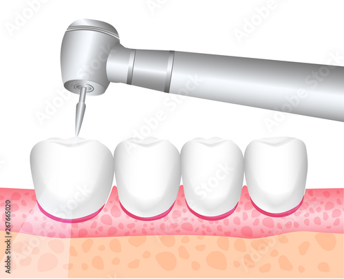 Dental treatment, dentistry. Dental instrument. Dental drill. The treatment of toothaches, drilling teeth. Vector illustration