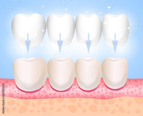 Veneers, Lumineers, onlays, microprosthesis. Installation of veneers. Aesthetic medicine. Direction dentistry orthopedics